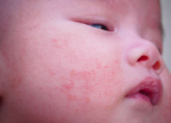 Sve više beba u Srbiji ima ekcem i alergije, a ovo je glavni razlog tome
