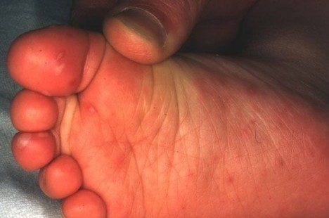 Virus koji napada dlanove, usta, tabane – (HAND MOUTH FOOT DISEASE)