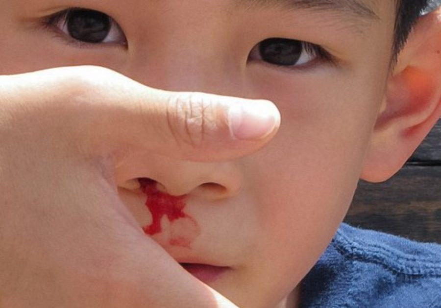 Krvarenje iz nosa kod dece