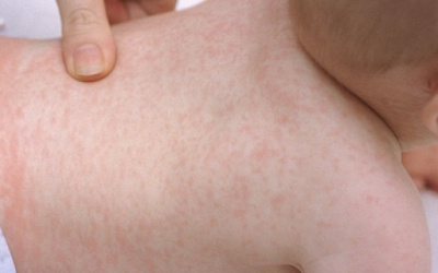 Trodnevna groznica, Rozeola ili Osip posle temperature - Šta treba znati