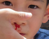 Krvarenje iz nosa kod dece
