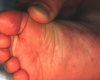Virus koji napada dlanove, usta, tabane – (HAND MOUTH FOOT DISEASE)