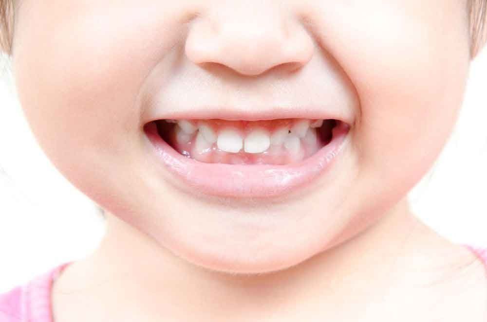 Obavezno lečite mlečne zube